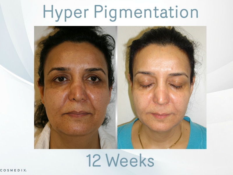 Medico Beauty Advanced Skin Results