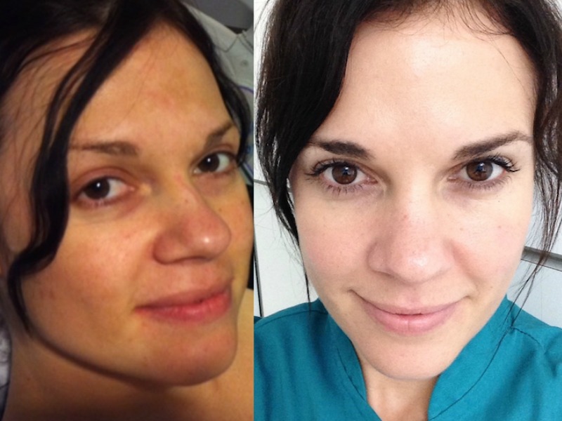 Hyperpigmentation #TransformationTuesday – Estie Claassen