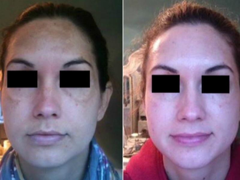 Melasma #TransformationTuesday – Penelope, London