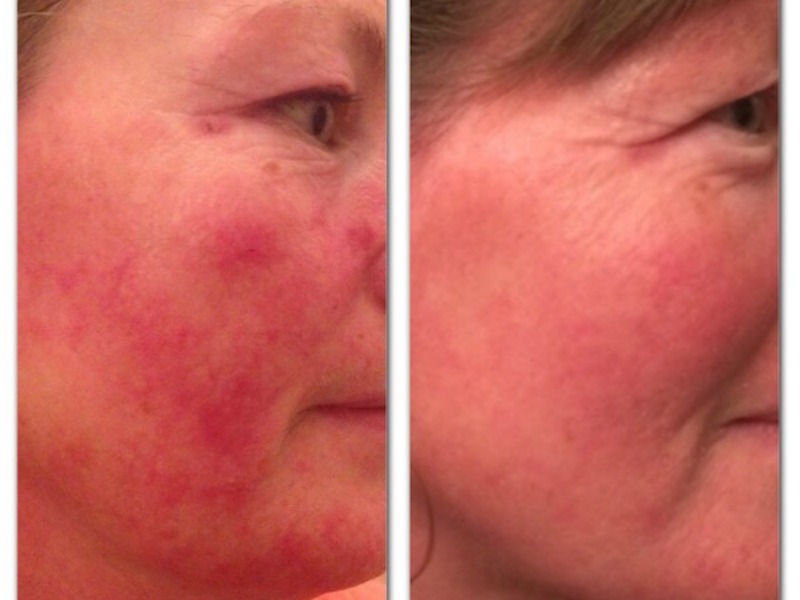 Rosacea Treatment – Christine Berney