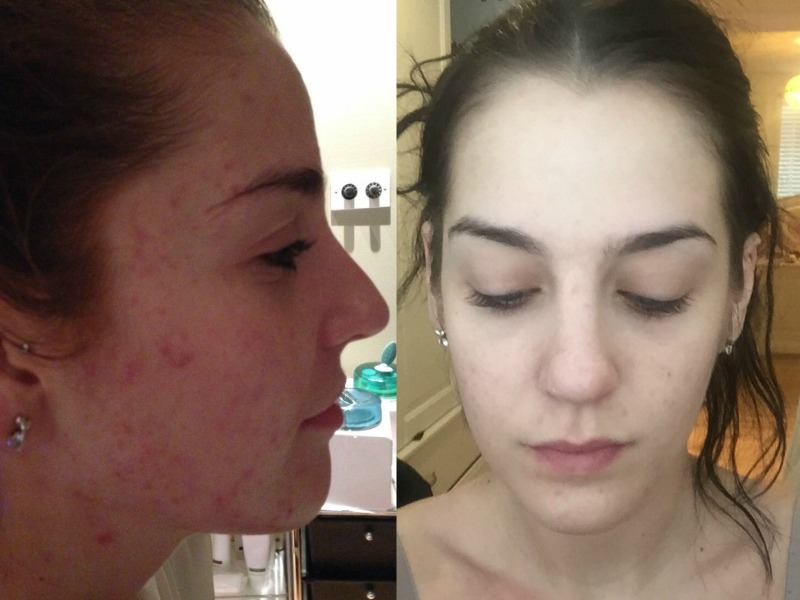 Acne – Transformation Tuesday