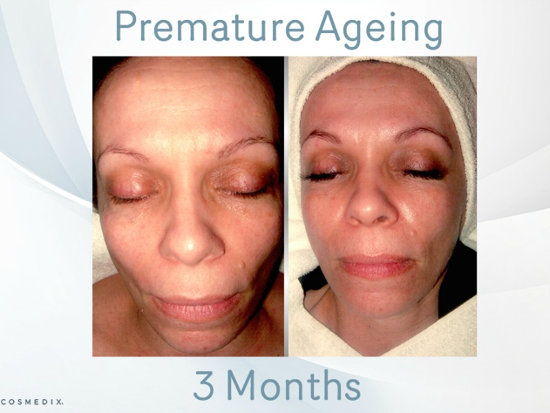 Premature ageing – Transformation Tuesday