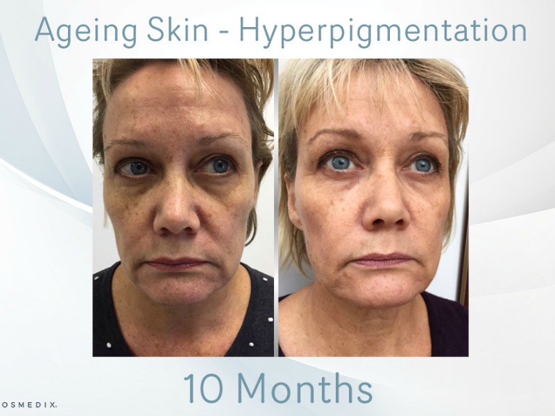 Ageing Skin – Transformation Tuesday