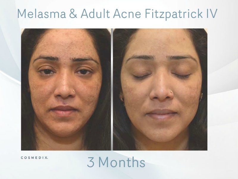 Melasma – Transformation Tuesday