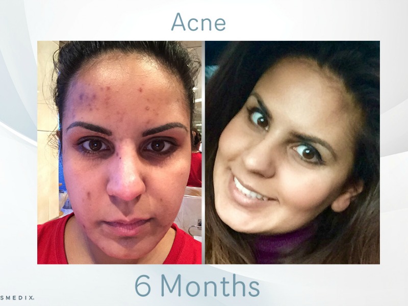 Transformation Tuesday – Adult Acne & Scarring