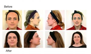 Treat Melasma with COSMEDIX