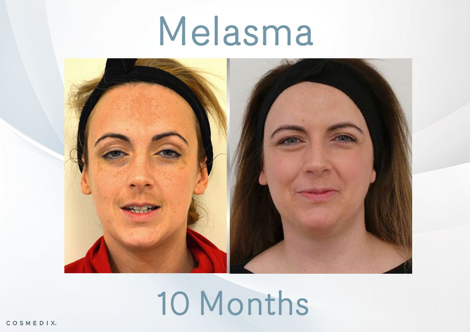Transformation Tuesday – Treat Melasma with Cosmedix