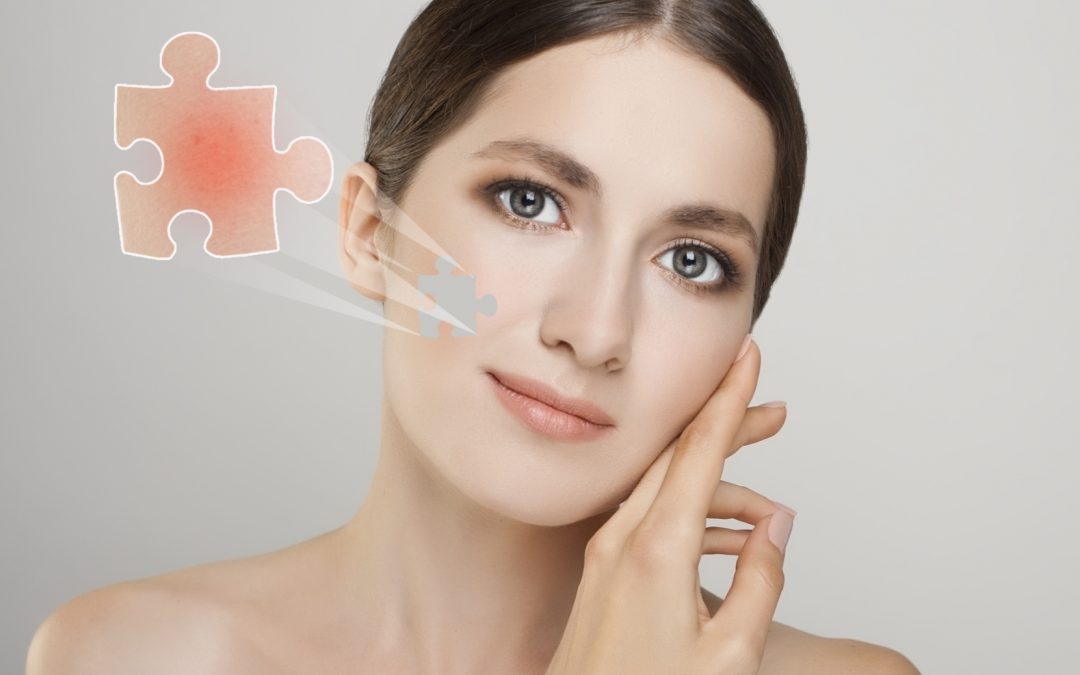 Rosacea Causes – Groundbreaking Discoveries explain common triggers of redness and spots