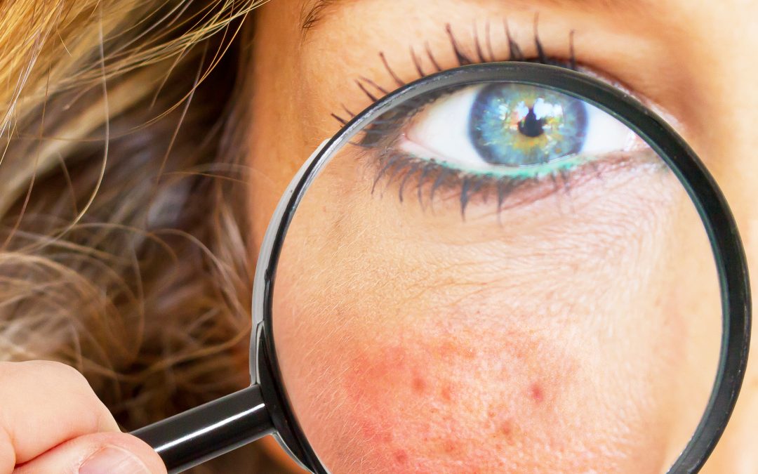 Rosacea Symptoms – Decode Your Rosacea Subtype